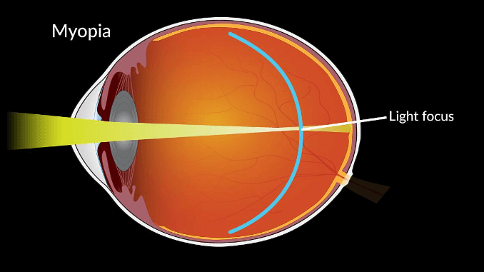 Low-Dose Atropine Eyedrops No Better Than Placebo for Slowing Myopia ...