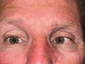 Dr. Benjamin Ticho Strabismus Before