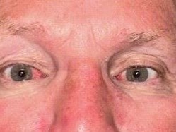 Dr. Benjamin Ticho Strabismus After