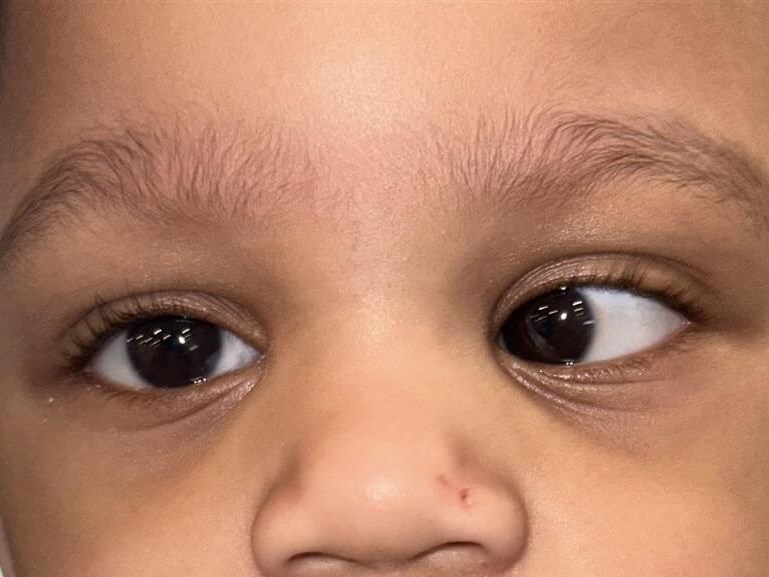 Strabismus Surgery - Esotropia Before
