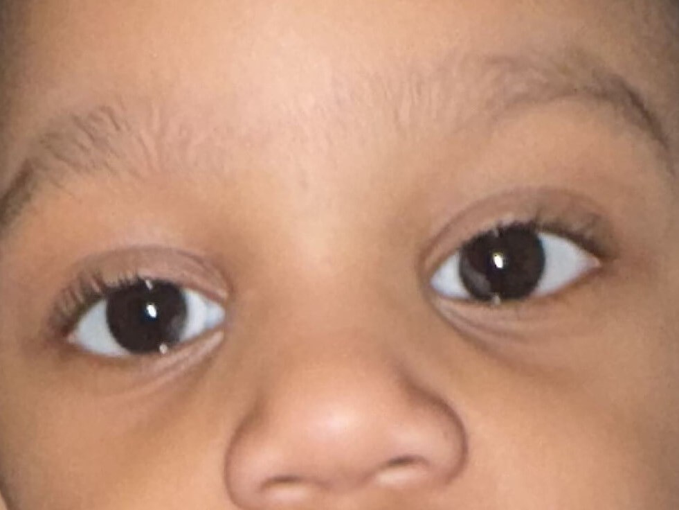 Strabismus Surgery - Esotropia After