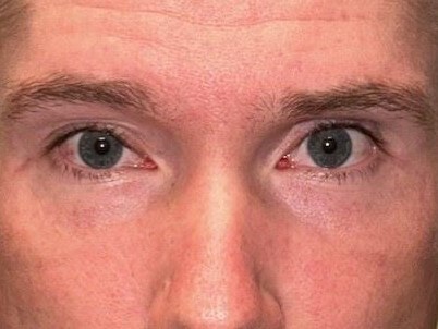 Ptosis Surgery After