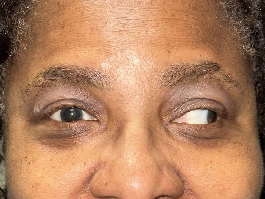 Strabismus Surgery: Exotropia Before