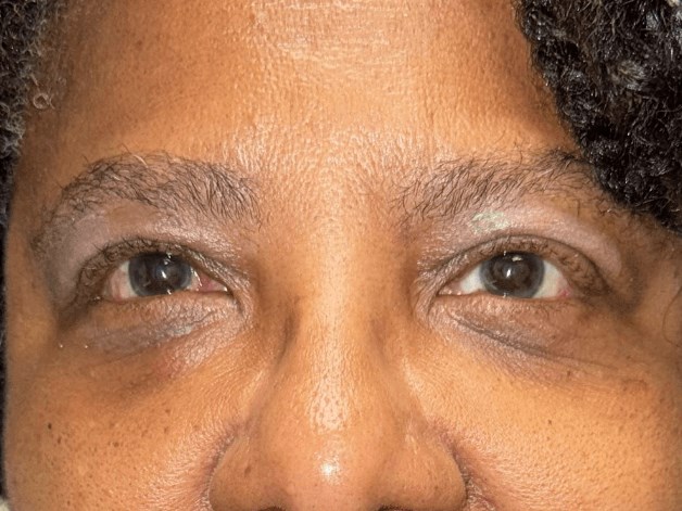 Strabismus Surgery: Exotropia After