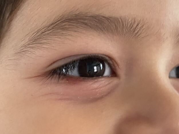 Right Lower Eyelid After
