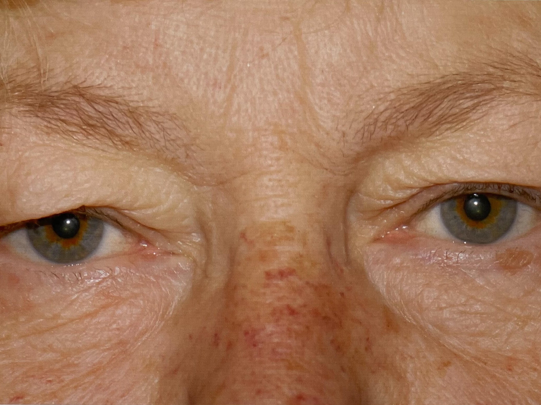 Upper Eyelid Ptosis Repair Before