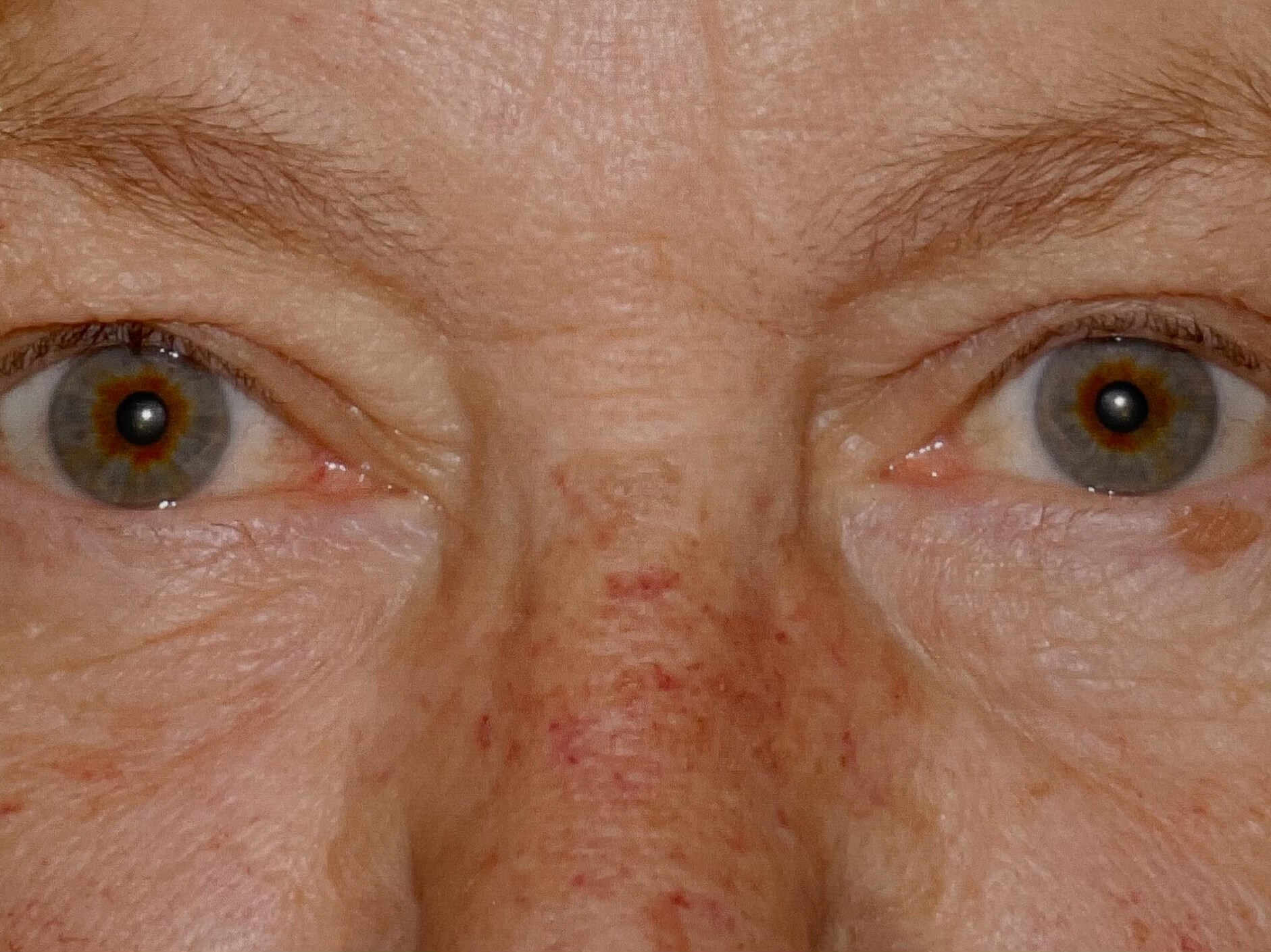 Upper Eyelid Ptosis Repair After