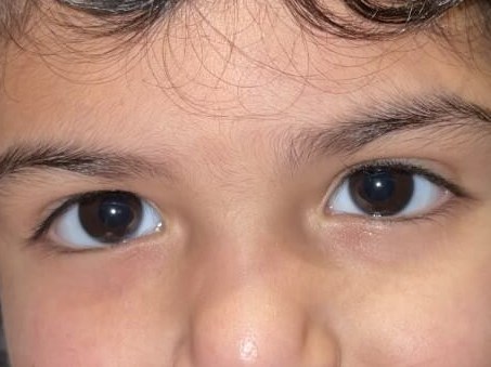 Strabismus Surgery After