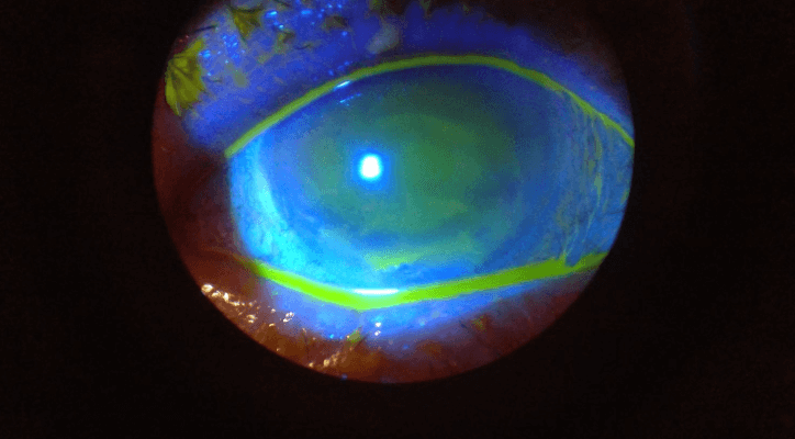 Corneal Ulcer