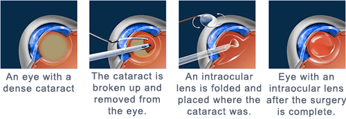 Cataract Surgery in Chicago Ridge, IL | Ticho Eye Associates
