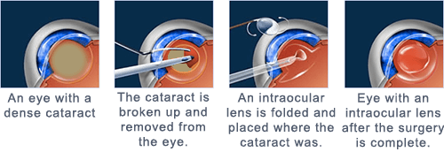 Cataract Surgery