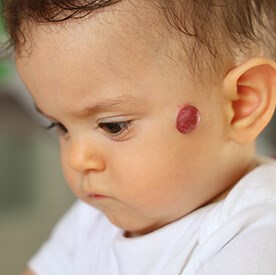 Infantile Hemangioma